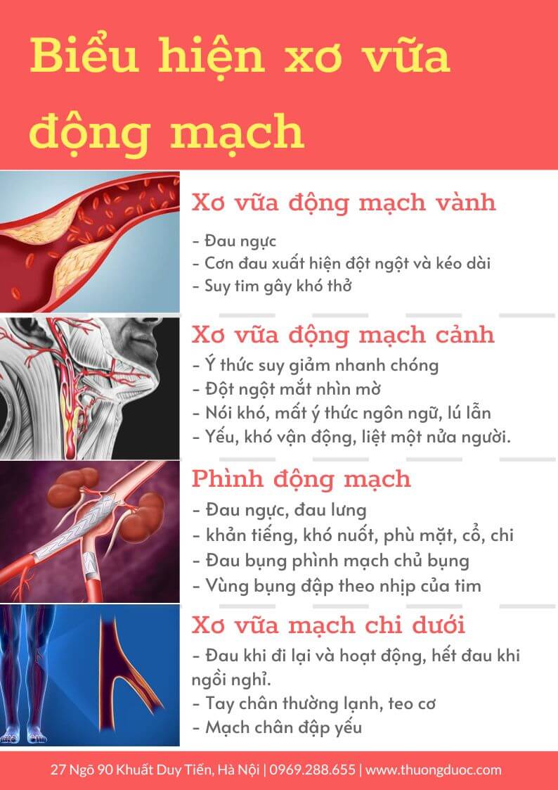 Các biểu hiện của bệnh xơ vữa động mạch