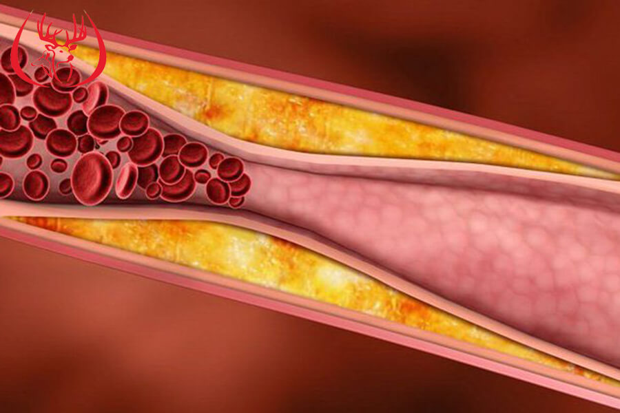Các phương pháp chẩn đoán xơ vữa động mạch