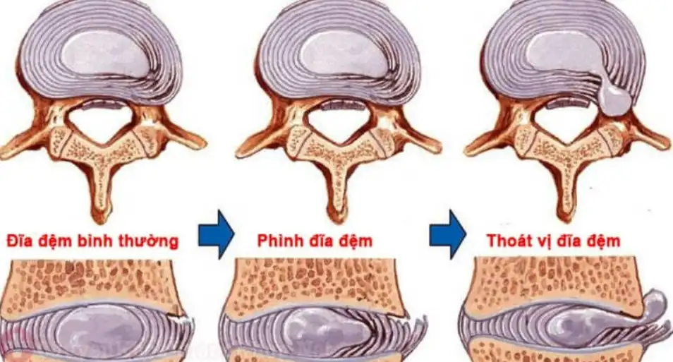 4 giai đoạn của bệnh thoát vị đĩa đệm