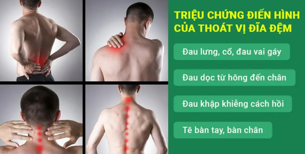 Biểu hiện của bệnh thoát vị đĩa đệm