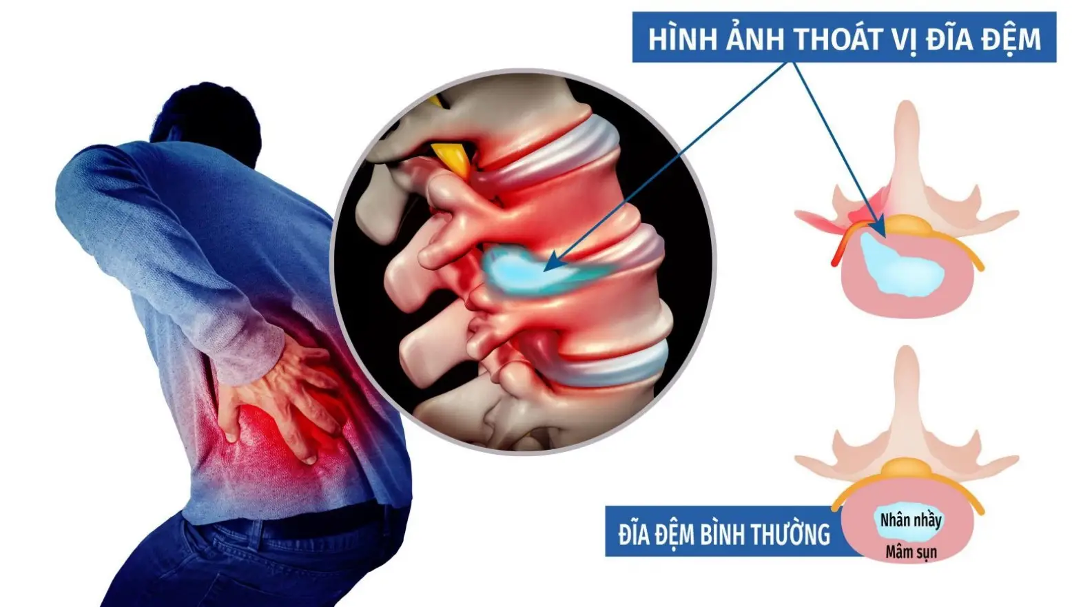 Hình ảnh của thoát vị đĩa đệm