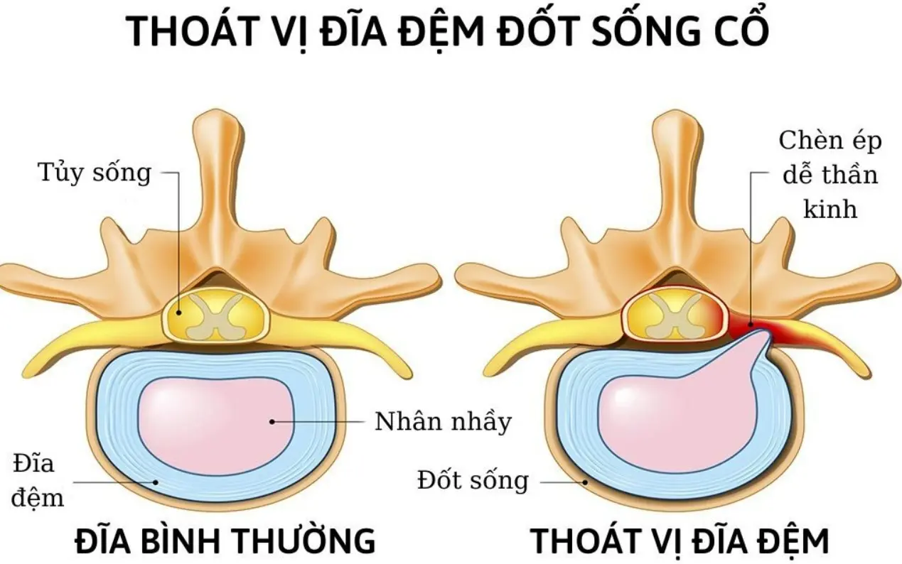 Thoát vị đĩa đệm đốt sống cổ