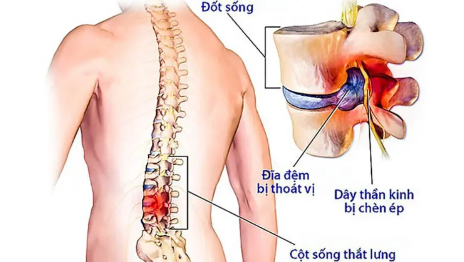 Thoát vị đĩa đệm là bệnh gì