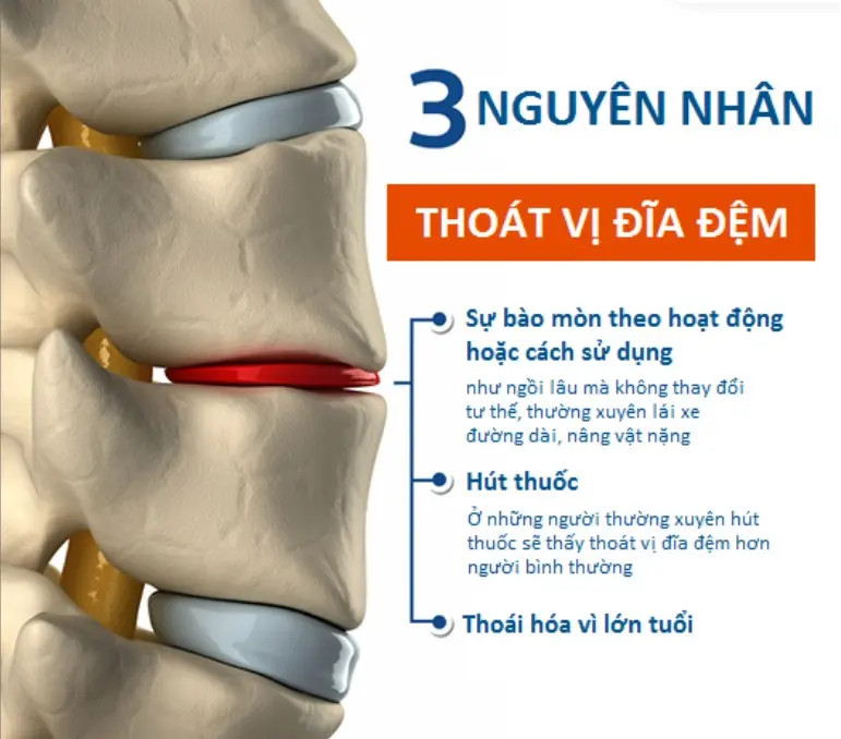 Yếu tố làm tăng tỷ lệ mắc bệnh thoát vị đĩa đệm