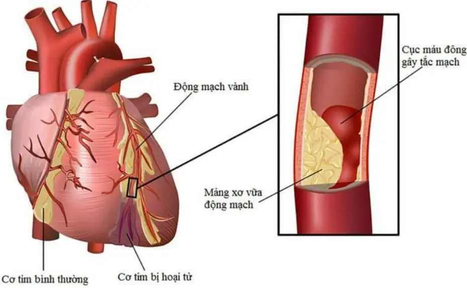 Bệnh mạch mạch vành