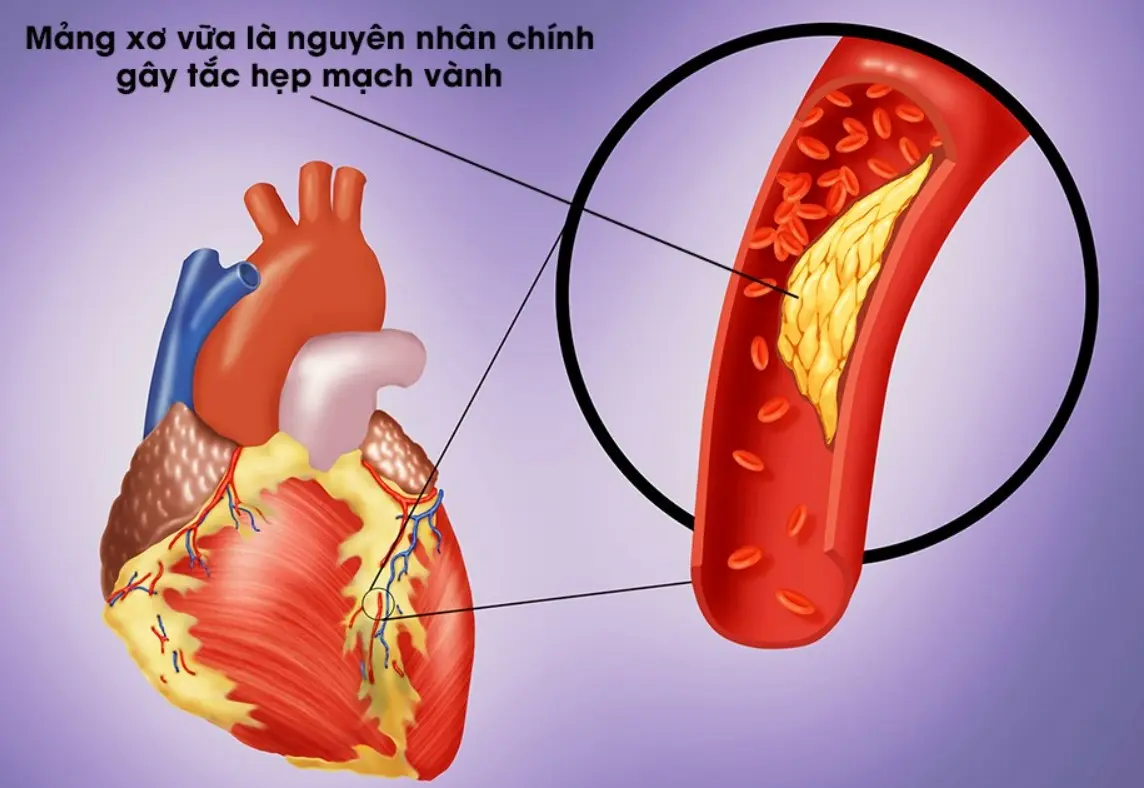 Bệnh mạch vành do mảng xơ vữa
