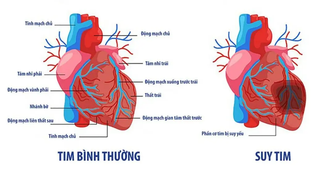Bệnh tim mạch vành gây ra suy tim