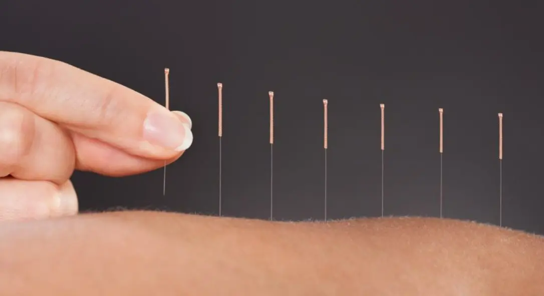 Châm cứu chữa xương khớp