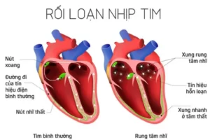 Tim mạch đập nhanh có nguy hiểm không? Cách điều trị tại nhà