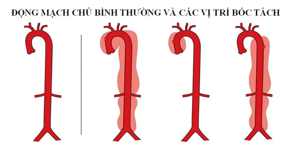 Phình động mạch chủ bóc tách