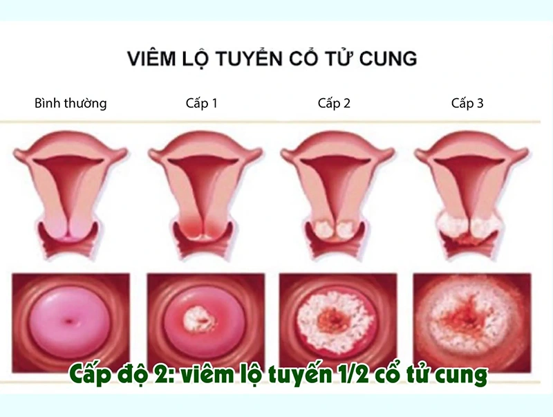 Bệnh phụ khoa có nguyên nhân gì