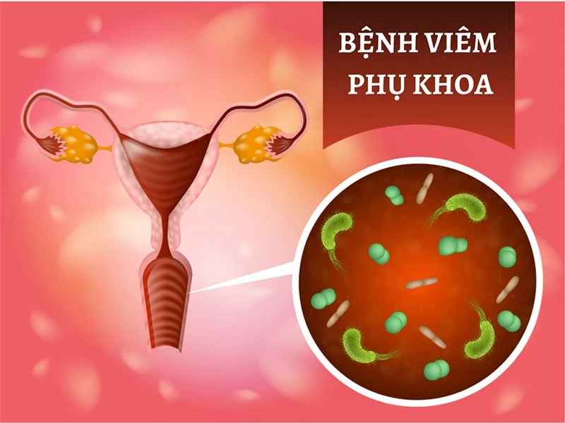 Bệnh viêm nhiễm phụ khoa