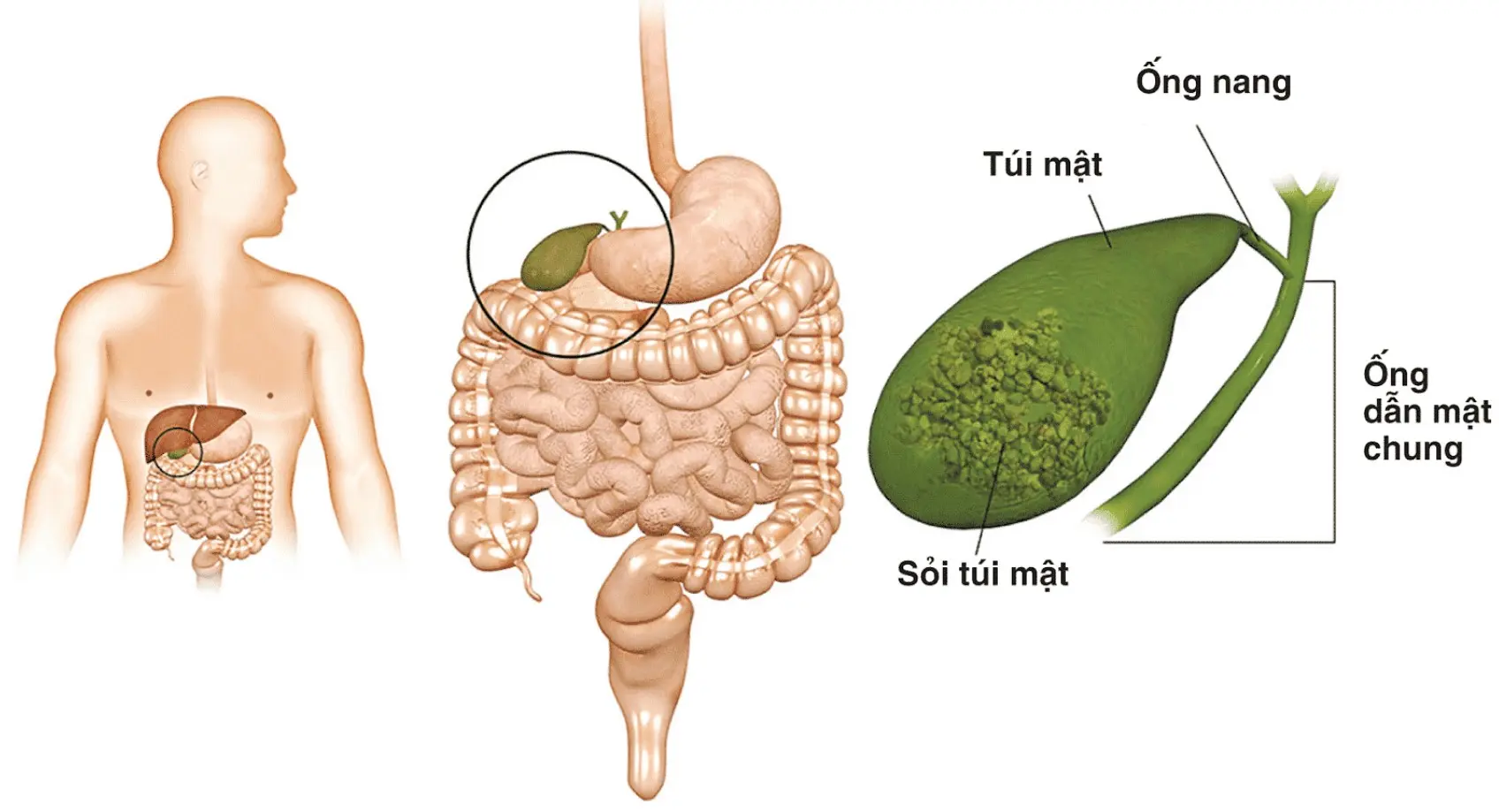 Bệnh sỏi mật là gì