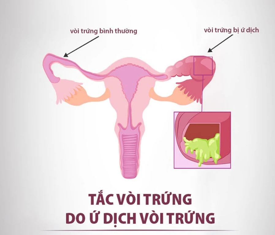 Nguyên nhân gây tắc vòi trứng