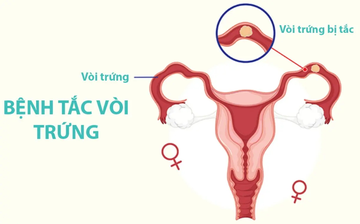 Bệnh tắc vòi trứng ở phụ nữ