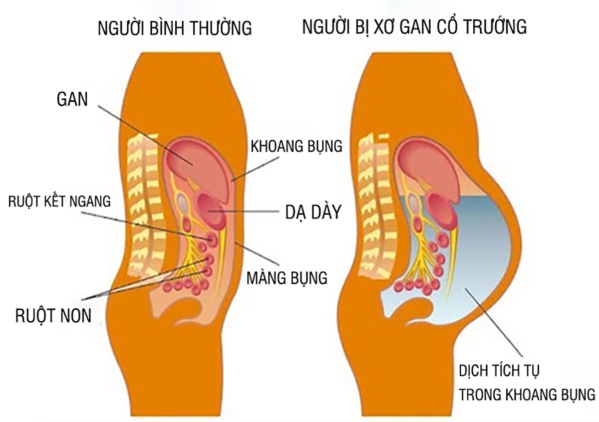 Xơ gan cổ trướng và những điều bạn cần biết
