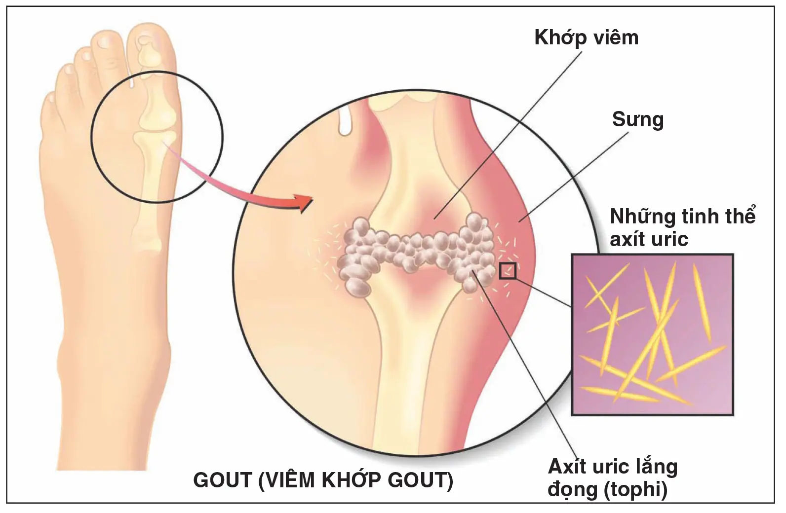 Nguyên nhân gây bệnh gút