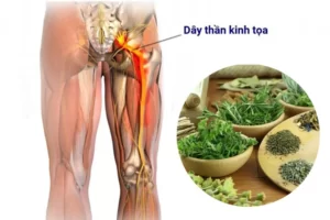 Cây thuốc nam chữa đau dây thần kinh tọa tại nhà hiệu quả 