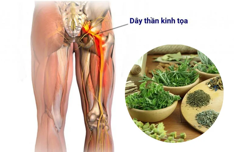 Cây thuốc nam chữa đau dây thần kinh tọa rất hiệu quả