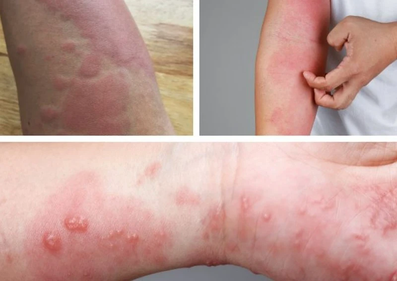 Triệu chứng ngứa da phổ biến