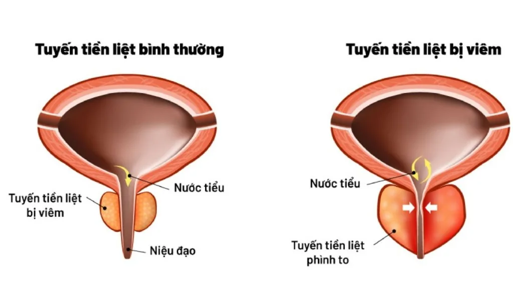 Bệnh viêm tuyến tiền liệt