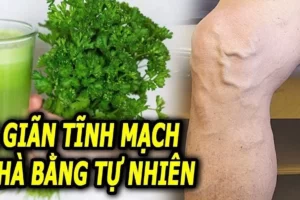 TOP 9+ Cây thuốc nam chữa suy giãn tĩnh mạch hiệu quả nhất