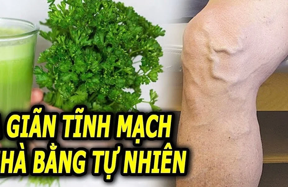 Sử dụng cây thuốc nam chữa suy giãn tĩnh mạch 
